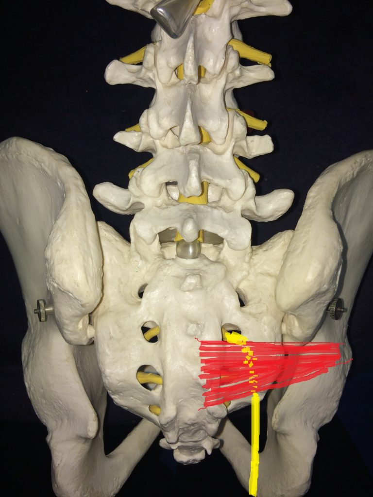 piriformis syndrome is a common cause of sciatica