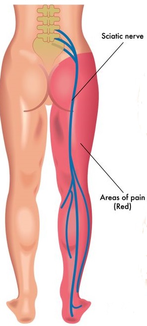 Sciatica pattern from L5/S1 nerve root irritation. This is the L5/S1 pain pattern.