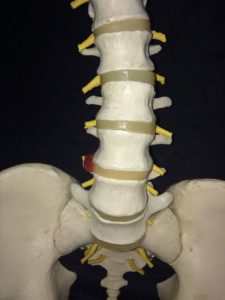Picture of the lumbar spine, or lower back, showing the nerve roots that form the sciatic nerve