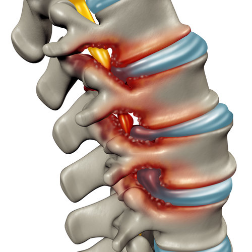 a spine with stenosis