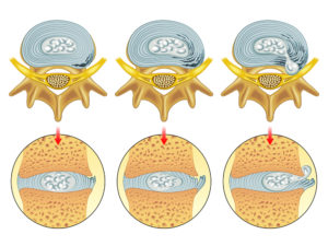 Illustration of different disc bulges to explain disc herniation recovery time