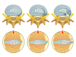 Illustration of different disc bulges to explain disc bulge recovery time. Helps to guide selection of sciatica exercises