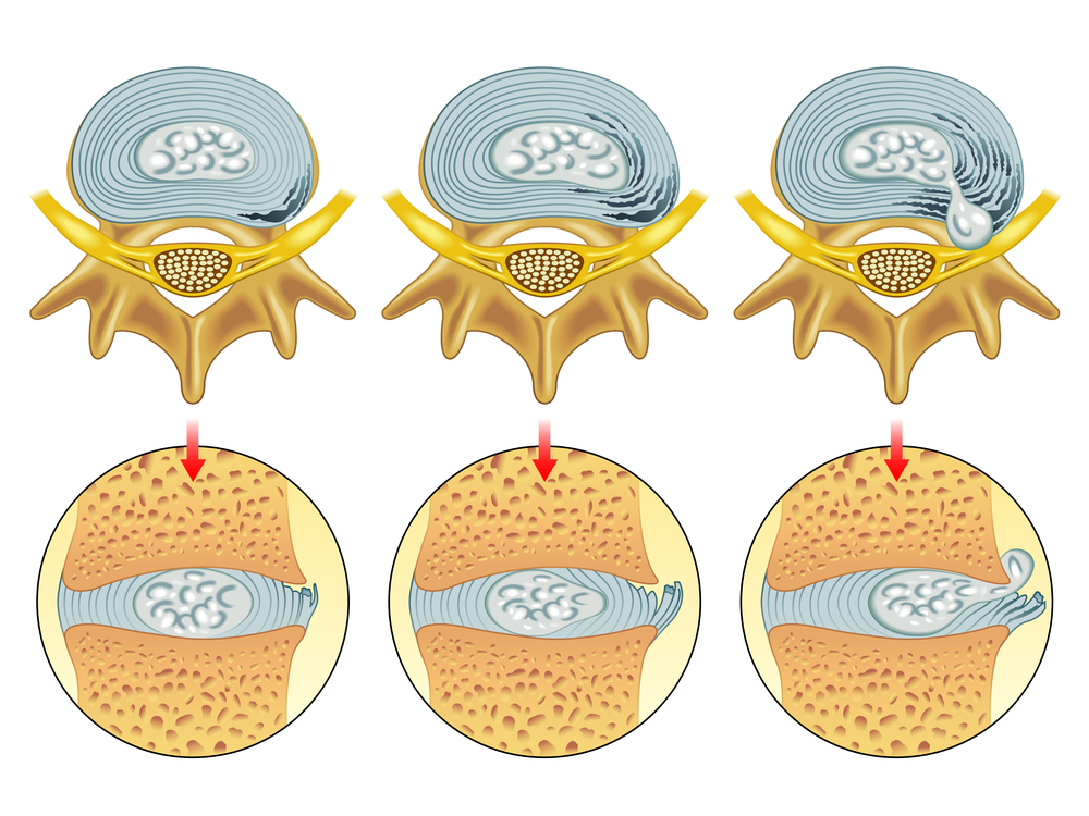 Here, you can see three disc bulges of different severity. The far right one is a herniated disc.