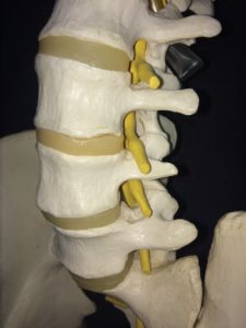 Bulging disc recovery time illustrated through pictures of normal nerve root in spine. Illustrating how smoking and sciatica have a strong relationship