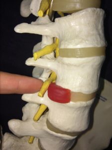 Herniated disc recovery time explained with pictures illustrating how a nerve root exits the spine