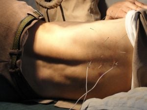 Another type of acupuncture, which can be quite dramatic and elicit a placebo effect which can add to the perceived pain relief from sciatica and back pain