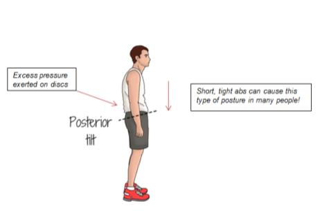 The truth about tight abs from core training. This is a posterior pelvic tilt