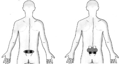 Placement of TENS pads for sciatica relief