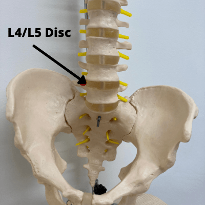 image to show the l4/l5 disc