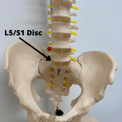 l5-s1 disc bulge recovery time, l5-s1 symptoms, l5-s1 pain symptoms, l5-s1 pinched nerve exercises, l5-s1 pain pattern, l5-s1 disc bulge symptoms
