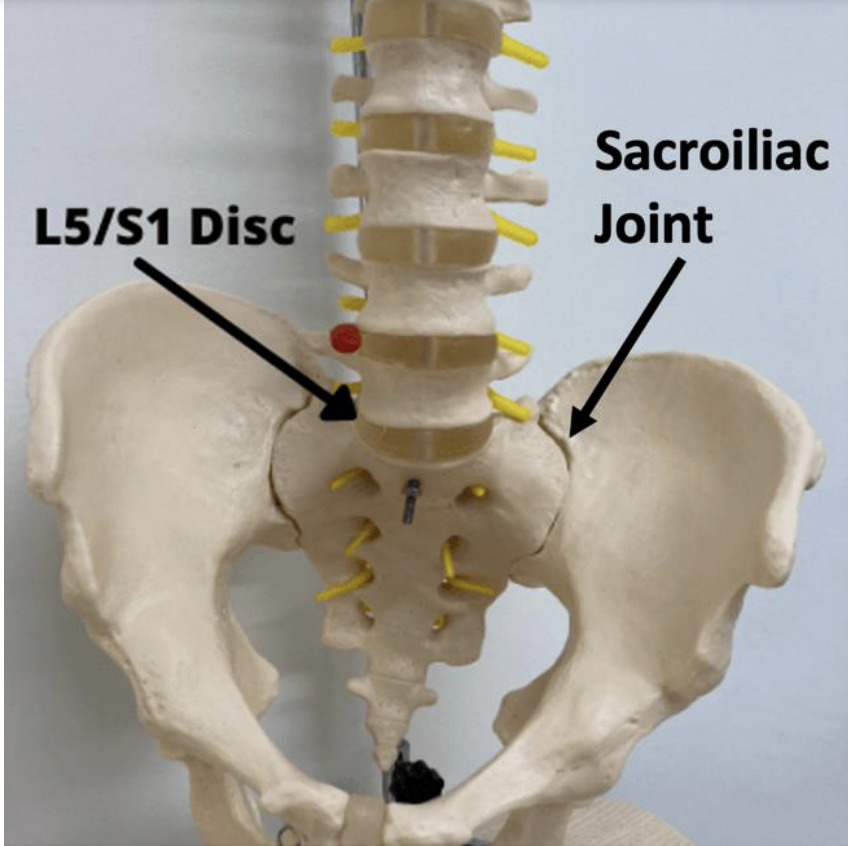 Which type of sciatica do I have? It could be sacroiliac joint dysfunction.