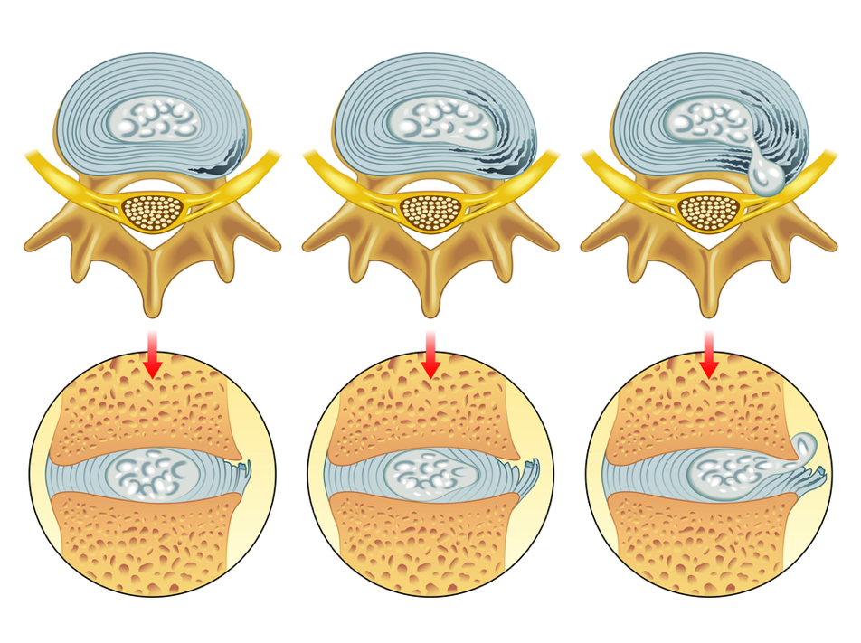 Different stages of a herniated disc