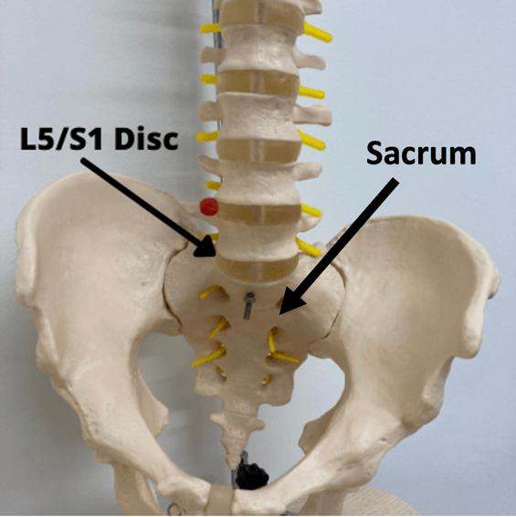 Image to show the L5/S1 disc and how a bulge or herniation here can cause sciatica.